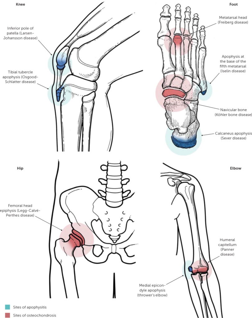 Traction Apophysitis – Protecting our younger athletes – Physioactive